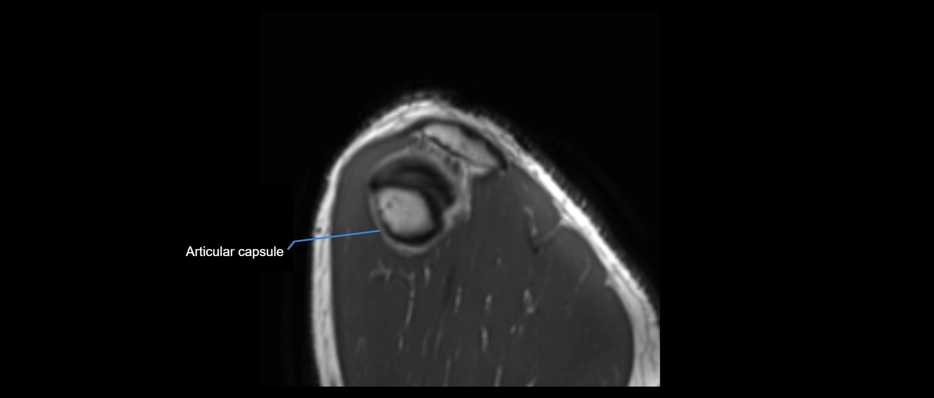 shoulder ligaments sagittal  cross sectional anatomy 3T MRI AI enhanced radiology image -img-00001-00055.webp